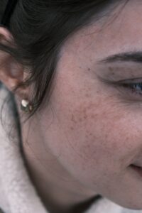 How to Get Rid of Dark Spots on Face