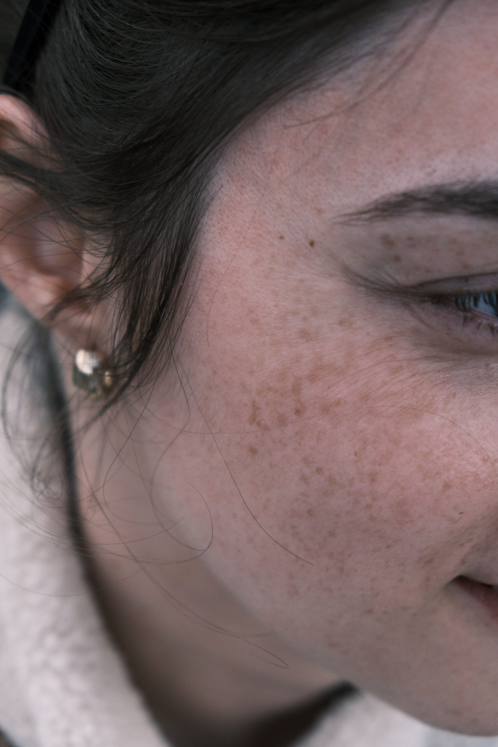 How to Get Rid of Dark Spots on Face