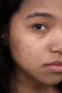 korean skincare for dark spots